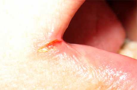 Ikke forkølelsessår sår på læben forkølelsessår (herpes)